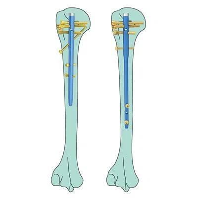 Basic Orthopedic Tool Kit best