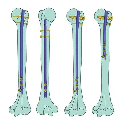 Basic Orthopedic Tool Kit best